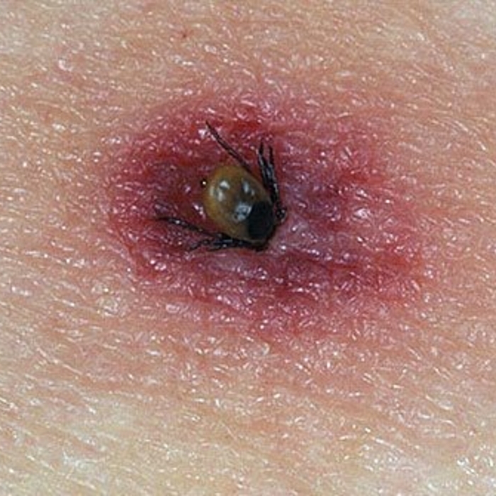 Tick Bite